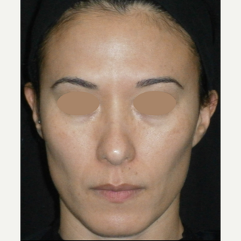 35-44 year old woman treated with Laser Treatment after 3128202