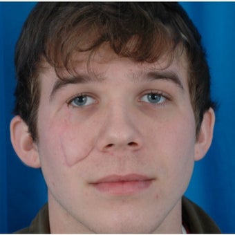 18-24 year old man treated with Scars Treatment before 2121238