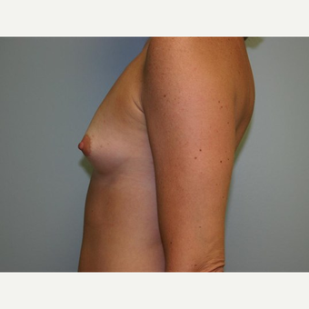 Breast Augmentation before 3560733