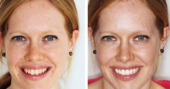 Teeth Whitening before 3093771
