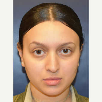 18-24 year old woman treated with Nose Surgery before 3013599