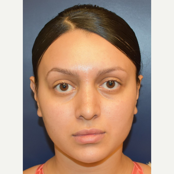 18-24 year old woman treated with Nose Surgery after 3013599