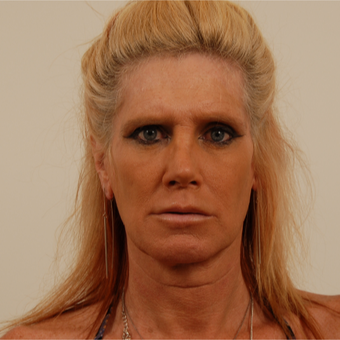 50 year old transgender woman underwent Facial Feminization Surgery before 3109945