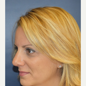 35-44 year old woman treated with Nose Surgery after 3131231