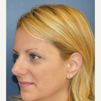 35-44 year old woman treated with Nose Surgery before 3131231