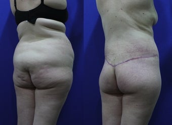 32 Year Old Female Treated for Abdominal Apron & Sagging Buttocks before 1109119