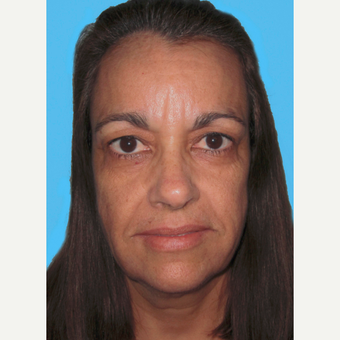 Facelift before 3824971