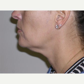 45-54 year old woman treated with Kybella before 2607293