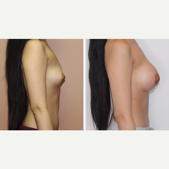 25-34 year old woman treated with Breast Augmentation after 3333126