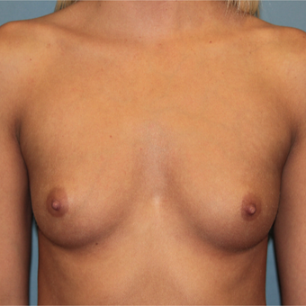 28 year old has breast augmentation with Natrelle Breast Implants before 3465216