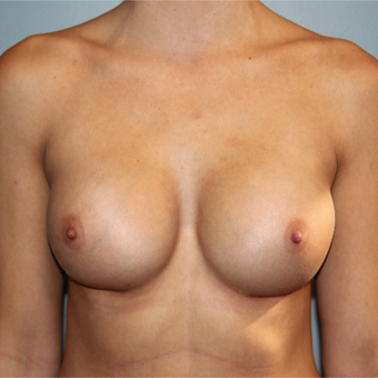 28 year old has breast augmentation with Natrelle Breast Implants after 3465216
