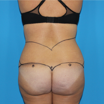 35-44 year old woman treated with Liposuction before 3332853