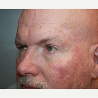 55-64 year old man treated with Brow Lift before 3708688