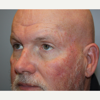 55-64 year old man treated with Brow Lift after 3708688