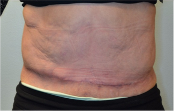68 year old woman treated with panniculectomy along with abdominal wall reconstruction after 2562574