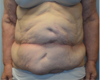 68 year old woman treated with panniculectomy along with abdominal wall reconstruction before 2562574