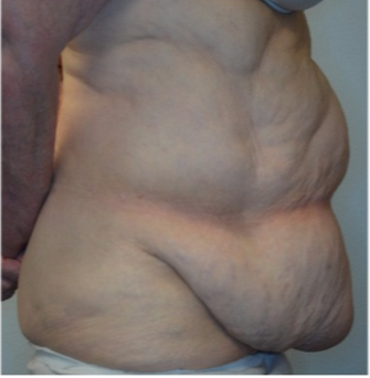 68 year old woman treated with panniculectomy along with abdominal wall reconstruction 2562574