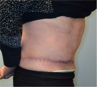 68 year old woman treated with panniculectomy along with abdominal wall reconstruction 2562574