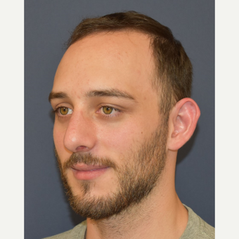 18-24 year old man treated with Nose Surgery after 3067113