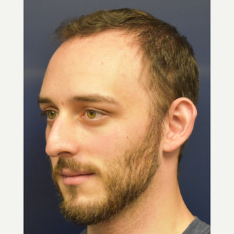 18-24 year old man treated with Nose Surgery before 3067113