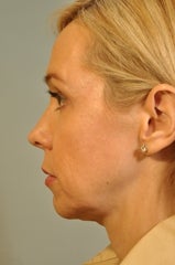 Chin Augmentation added to a surgery 658571