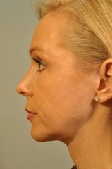 Chin Augmentation added to a surgery 658571