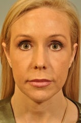 Chin Augmentation added to a surgery after 658571