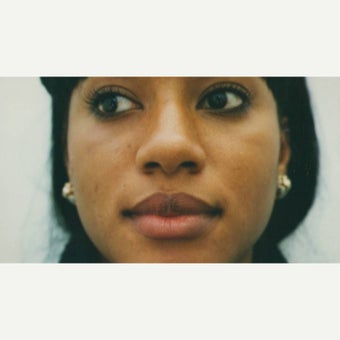 25-34 year old woman treated with African American Rhinoplasty before 2220219