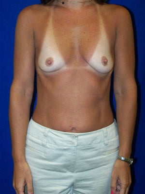 Breast Augmentation before 92692
