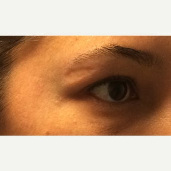 29 year old woman treated with Bellafill before 2541162
