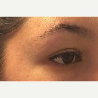 29 year old woman treated with Bellafill after 2541162