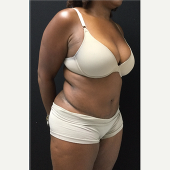 45-54 year old woman treated with Tummy Tuck after 3481540