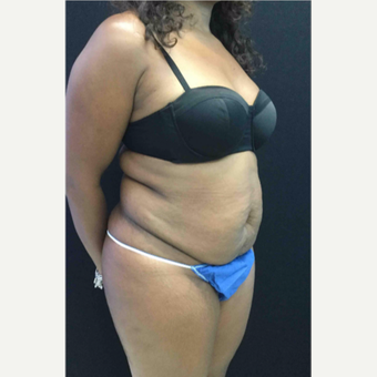 45-54 year old woman treated with Tummy Tuck before 3481540