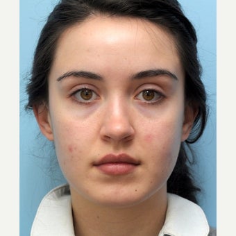 Eye Bags Treatment Using Restylane before 1747198