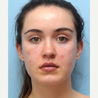 Eye Bags Treatment Using Restylane after 1747198