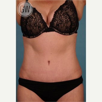 35-44 year old woman treated with Tummy Tuck + Circumferential Liposuction after 3016620