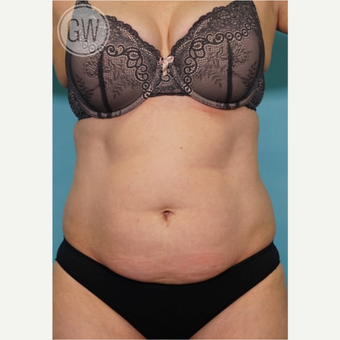 35-44 year old woman treated with Tummy Tuck + Circumferential Liposuction before 3016620