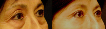 Lower Eyelid Surgery before 389794