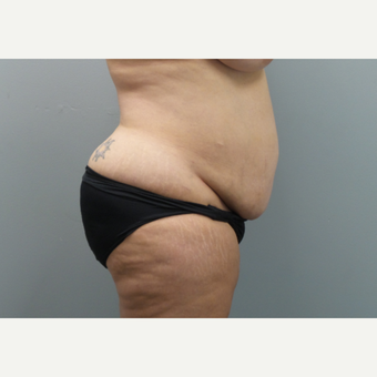 45-54 year old woman treated with Tummy Tuck before 3325694
