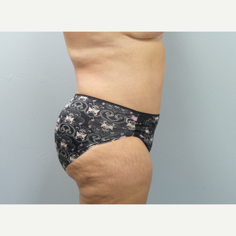 45-54 year old woman treated with Tummy Tuck after 3325694