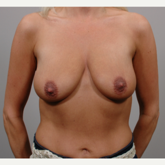 Breast Lift with Implants before 3052201