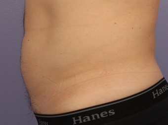 Cool Max to lower abdomen before 1322767
