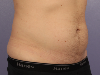 Cool Max to lower abdomen 1322767