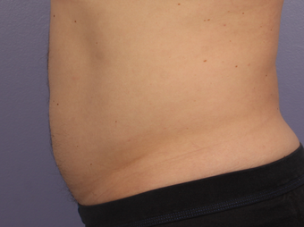 Cool Max to lower abdomen after 1322767
