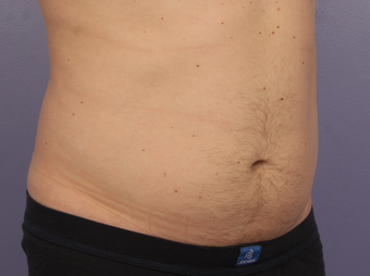 Cool Max to lower abdomen 1322767
