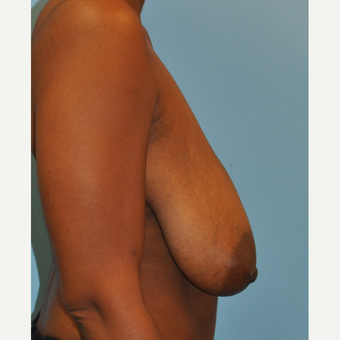 44 year old woman with 500 g breast reduction. 36 H cup to C cup. before 3304122