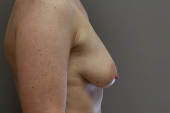 42 year old female, 5'9", 158 lbs., desires cosmetic improvement of breasts 1253864