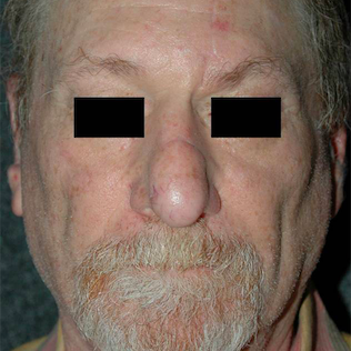 Mohs Surgery after 3711209