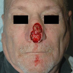 Mohs Surgery before 3711209