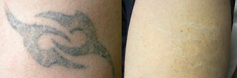 Tribal Tattoo Removal using PicoSure before 1248285